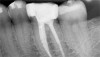 (11.) Postoperative radiograph taken 4 years after treatment, demonstrating 3- to 4-mm probing depths.