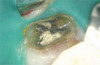 (14.) Intrasurgical photograph of regenerative treatment with mineralized FDBA and EMD.