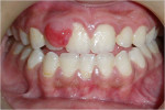 Figure 1  Preoperative photograph of growth arising from the labial interdental papilla of the maxillary right central and lateral incisors.