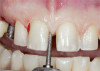 Fig 3. The titanium carrier fixture has been modified for sufficient occlusal and interproximal clearance.