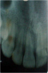 Figure 2  Intraoral periapical radiograph of maxillary anterior region showing no underlying bone involvement.