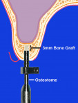 Figure  2  Bone graft plug in the osteotomy.