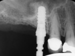 Figure  6  Radiograph of implant No. 3 after sinus elevation.