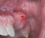 Figure  11  Large exostosis can be seen on the maxillary left molar region.