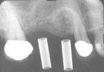 Figure  12  Preoperative image of the maxillary left area with radiographic markers.