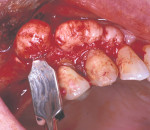 Figure  14  The exostoses on the maxillary right area were harvested using a chisel.