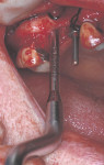Figure  15  Sinus floor elevation using a 2.8-mm angled osteotome.
