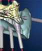 (30.) Virtual tooth setup and projected implant position.