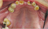 Fig 1. Initial clinical photograph showing absence of molars in right maxillary quadrant.