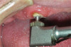 Fig 20. After placement of bone grafting putty in the defect, the implant was inserted. Note the remaining bone grafting putty on the buccal aspect of the implant.