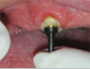 Fig 22. Final restoration after 1.5 years. Note the soft-tissue contour on the buccal aspect.