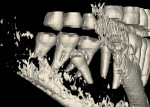 Figure 7  Panoramic view, Note the erosion of the distal root of the lower left first molar.
