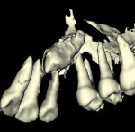 Figure 9: 3-D reformation with virtual removal of bone, maxillary right, palatally positioned impacted canine tooth. Note close proximity to the lateral incisor root apex.