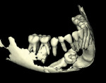 Figure 14 Complex odontoma, mandibular right, Note horizontally impacted mandibular right canine.