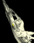 Figure 18  45-year-old man, dentigerous cyst, mandibular right side.
