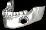 Figure 20  19-year-old woman, ameloblastoma, left mandible. Preoperative panorex (Fig 19), 3-D reformation (Fig 20), and stereolithographic model fabricated, osteotomy outlined, mandibular reconstruction plate pre-bent (Fig 21).