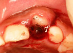 Figure 1  Initial intraoral view of total intrusion of tooth No. 10.