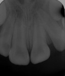 Figure 2  Initial periapical radiography of tooth