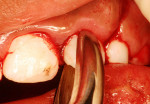 Figure 3  Intraoral view of surgical repositioning of the intruded tooth.