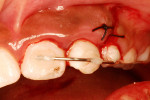 Figure 4  Intraoral view of the splinting with steel wire and composite resin. Also a suture of soft-tissue lesion.