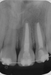 Figure 9  Periapical radiography at 3-year follow-up.