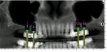 Figure 5  3-D digital view of the proposed implant placement location.