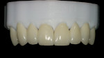 Figure 15  Lithium disilicate crowns on the solid SLA model.