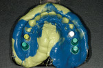 Figure 16  Final VPS impression of the implants; note the ideal position of each.