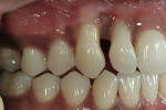 Figure 3  Preoperative right lateral view reveals the thin biotype of the patient’s gingival tissue.