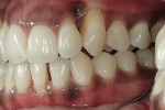Figure 4  Preoperative left lateral view reveals the thin biotype of the patient’s gingival tissue.