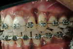 Figure 7  Left lateral view of the progress of tissue migration after 9 months of orthodontic extrusion. Note the gain of attached tissue.