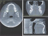 Fig 13. Virtual planning of a posterior implant (Fig 12) resulted in inadequate restorative running room for the crown emergence profile in the cross-sectional CBCT image. Revision (Fig 13) resulted in deeper positioning of the implant for restorative running room but necessitated transcrestal sinus elevation, possibly with the addition of bone via the osteotomy to tent the membrane.