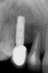 Figure 10b  Post-treatment radiographs showing migration of the osseous crest around the implants
