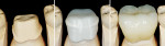 Figure 8  Clinical application of optimized all-ceramic restoration.