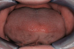 Figure 3  Augmentation results and implant placement. Note flattening of the palate from forces exerted by the tongue during mastication. Macroglossia developed as a result of unrestricted growth and hyperfunction in the masticatory process.