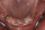 Figure 5  Mondial teeth in an overlapping set-up, showcasing the natural contouring of the papillae and esthetics of the upper and lower anterior teeth.