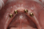 Figure 6  Mondial teeth in an overlapping set-up, showcasing the natural contouring of the papillae and esthetics of the upper and lower anterior teeth.