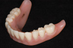 Figure 11  Upper and lower implant-borne prostheses.