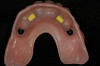View of a broken full-contour zirconia restoration that resulted from not following the required processing protocols.