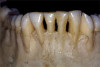 Fig 4. Left: This intraoral photograph taken with only a smartphone shows image distortion and poor color rendering. Right: This intraoral photograph was taken with a DSLR camera with an external flash and is much higher quality.