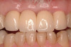 Figure 2: Assessment of implants to identify peri-implant disease.