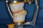Figure 3  Completed diagnostic wax-up on anatomically mounted casts.