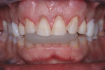Figure 4  Anterior bite record; note provisionals from mock-up remain on posterior to hold vertical dimension occlusal (VDO).