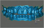 Figure 5  Digital impression scan of upper and lower anterior preps.