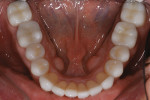 Figure 9: Postoperative, lower arch lithium disilicate veneers, and zirconia crowns in posterior.