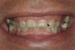 Figure 10  Preoperative smile prior to orthodontics and crown lengthening.
