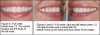 Fig 1. Preoperative smile photograph.