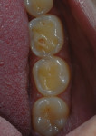 Figure 3  Inferior posterior teeth in detail showing the severe erosion with exposed dentin.
