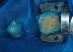 Figure 5  Acid-etching only in enamel surfaces with 37% phosphoric acid before the restorative procedures.