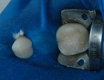 Figure 7  Insertion of composite resin initially in wear regions.